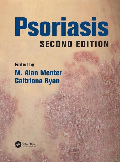 Psoriasis, Second Edition