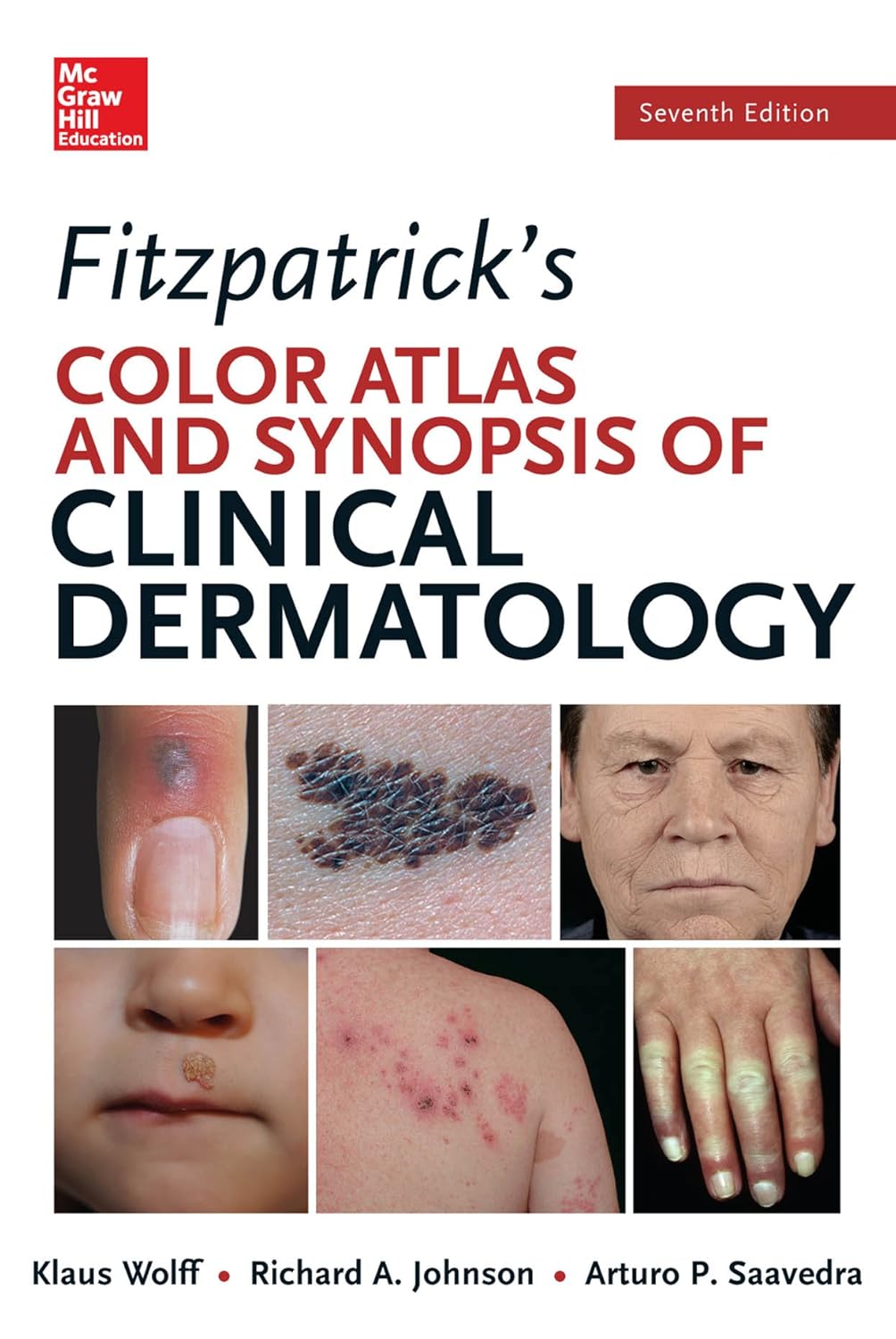 Fitzpatrick’s Color Atlas and Synopsis of Clinical Dermatology, 7th Edition