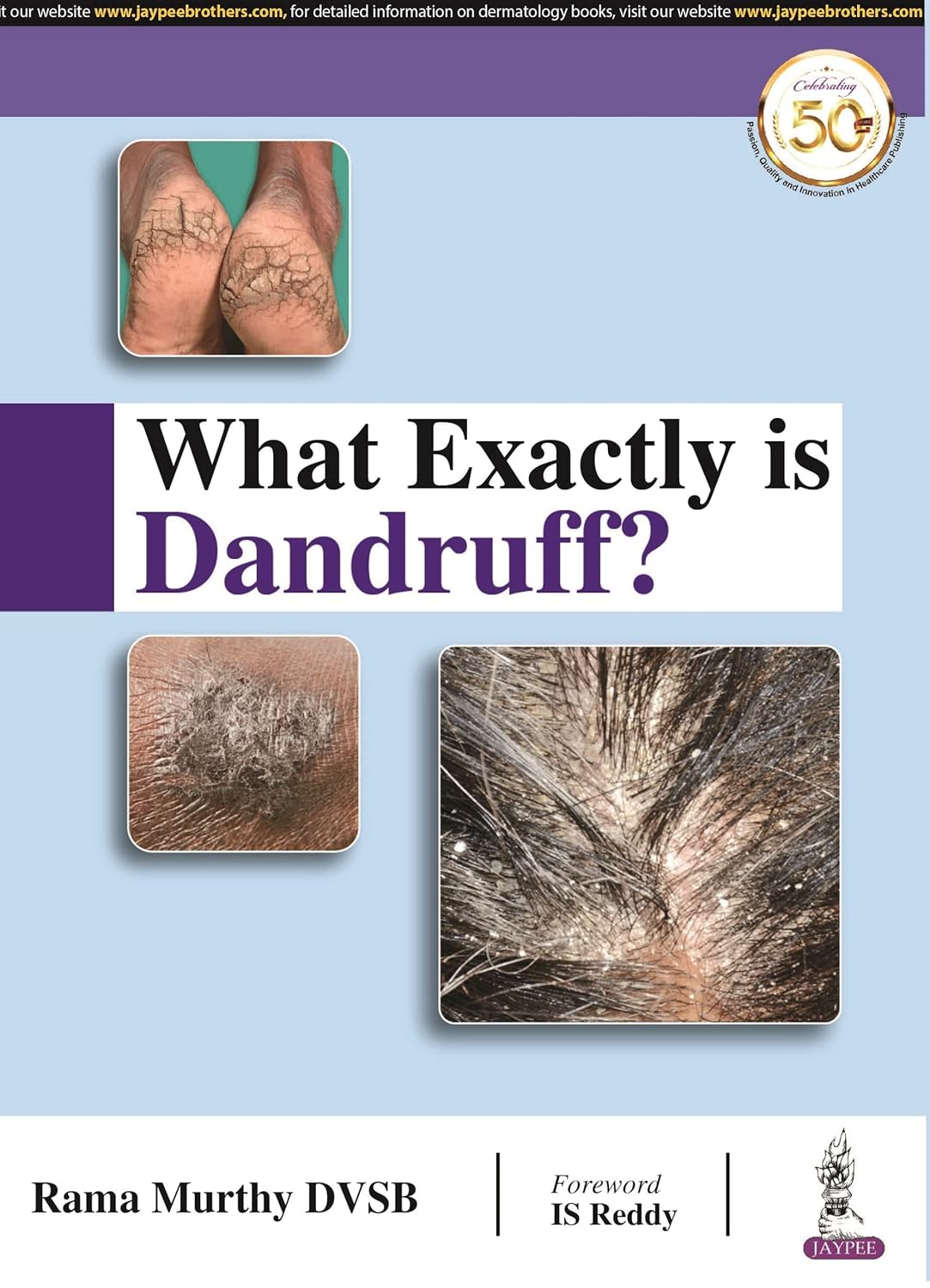 What Exactly is Dandruff