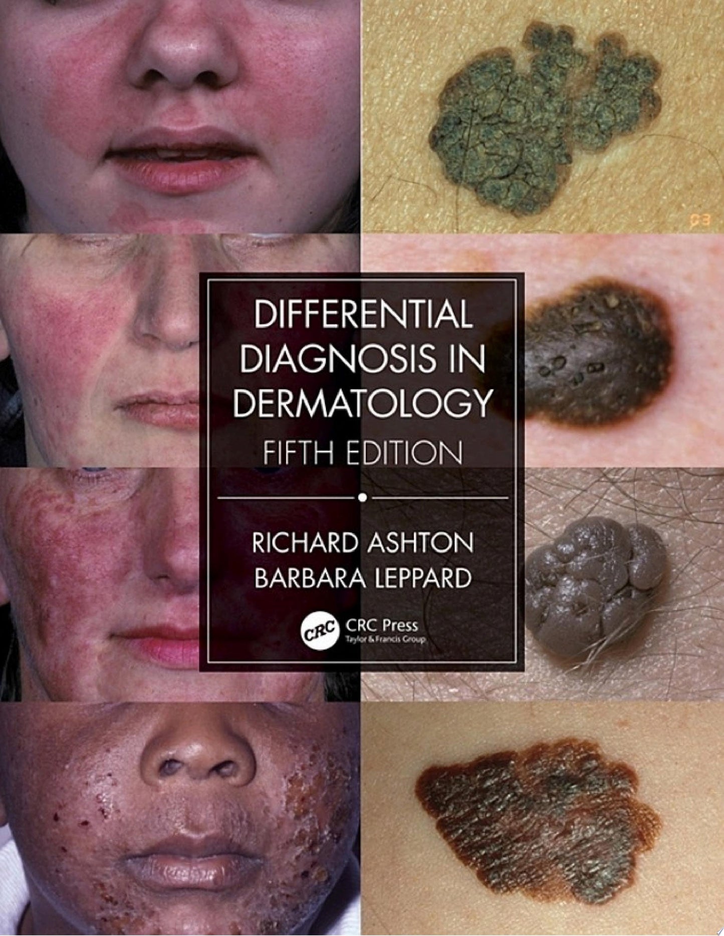 Differential Diagnosis in Dermatology, 5th Edition