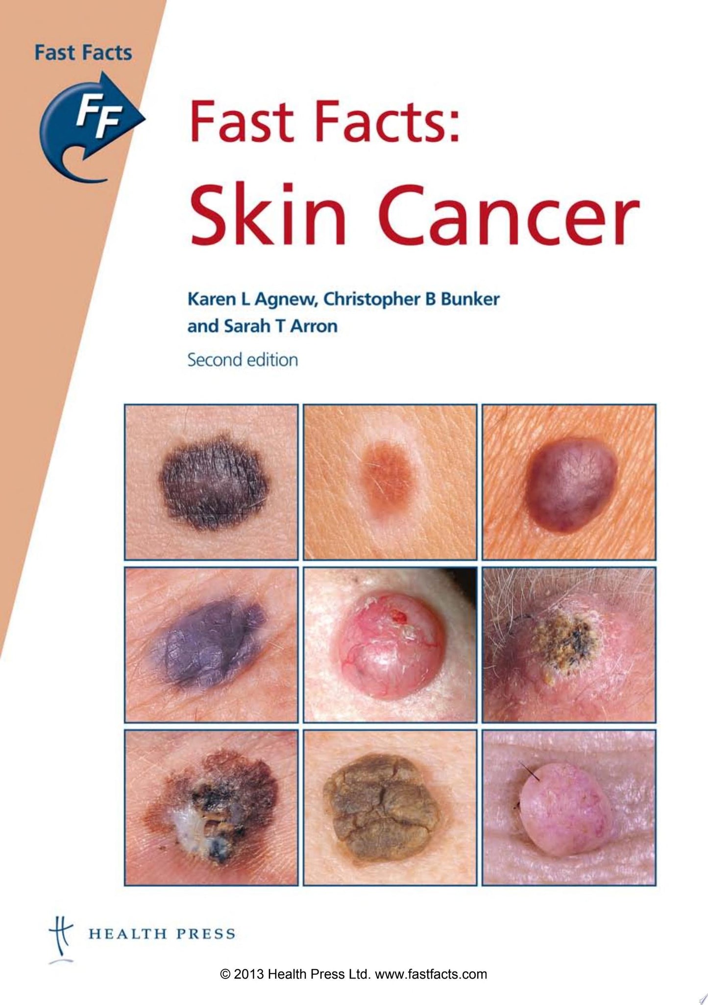 Fast Facts: Skin Cancer, 2e
