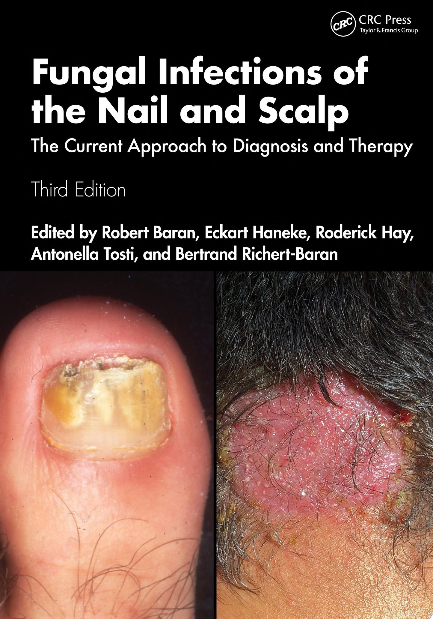 Fungal Infections of the Nail and Scalp: The Current Approach to Diagnosis and Therapy, 3rd Edition