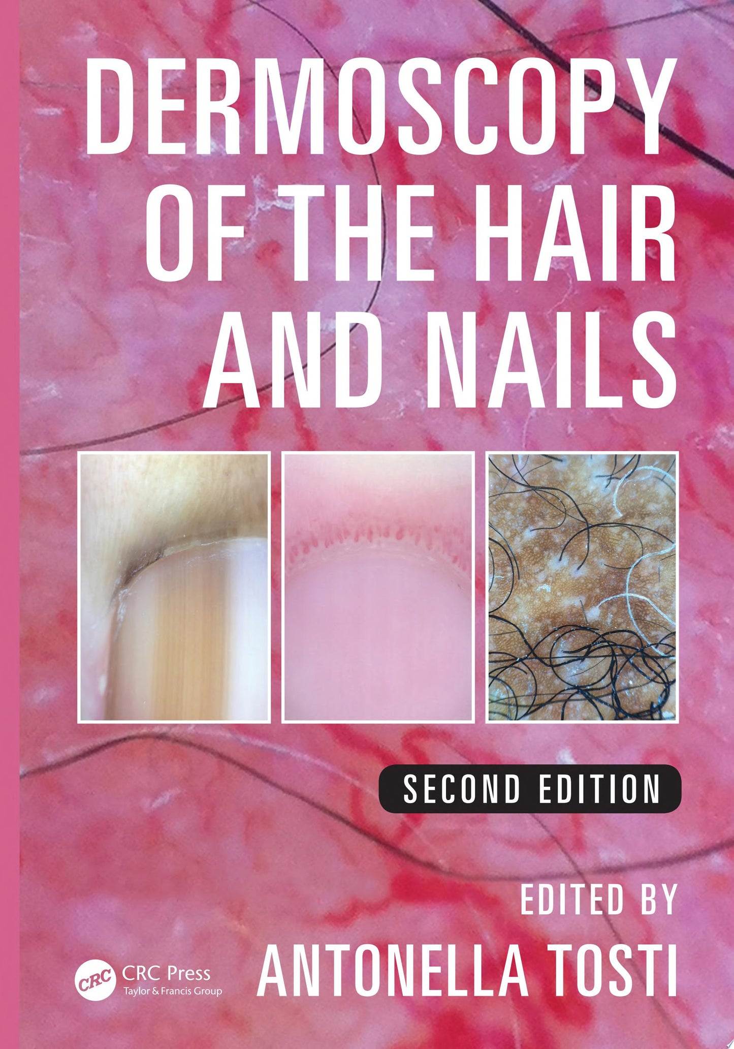 Dermoscopy of the Hair and Nails, Second Edition