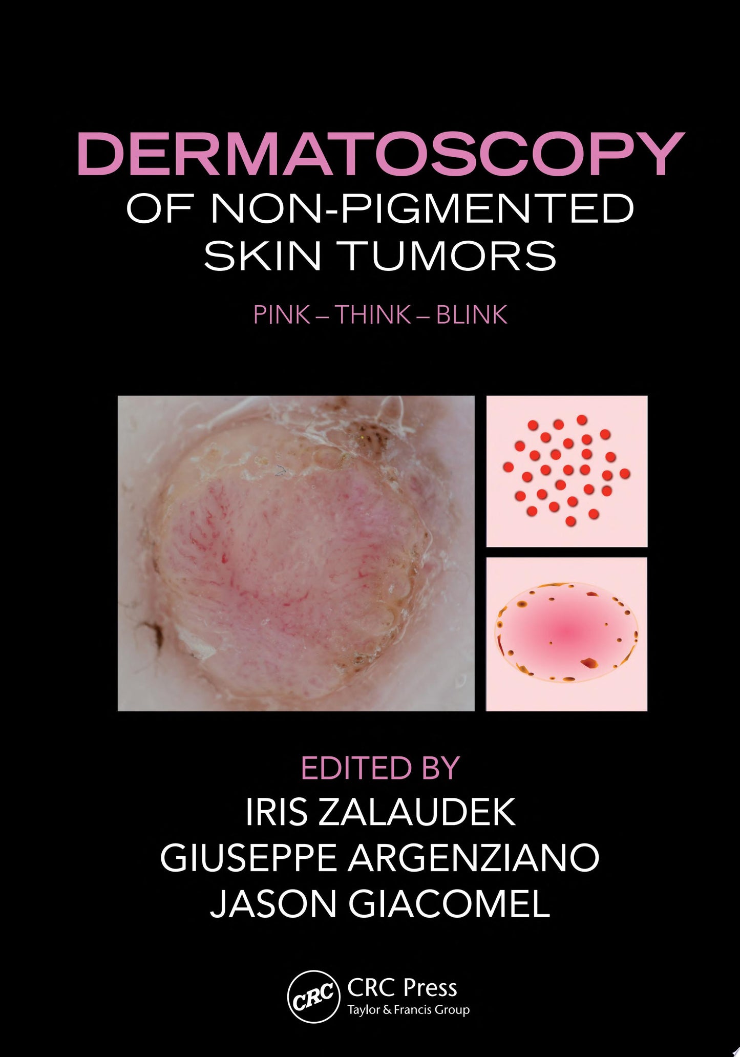 Dermatoscopy of Non-Pigmented Skin Tumors: Pink – Think – Blink