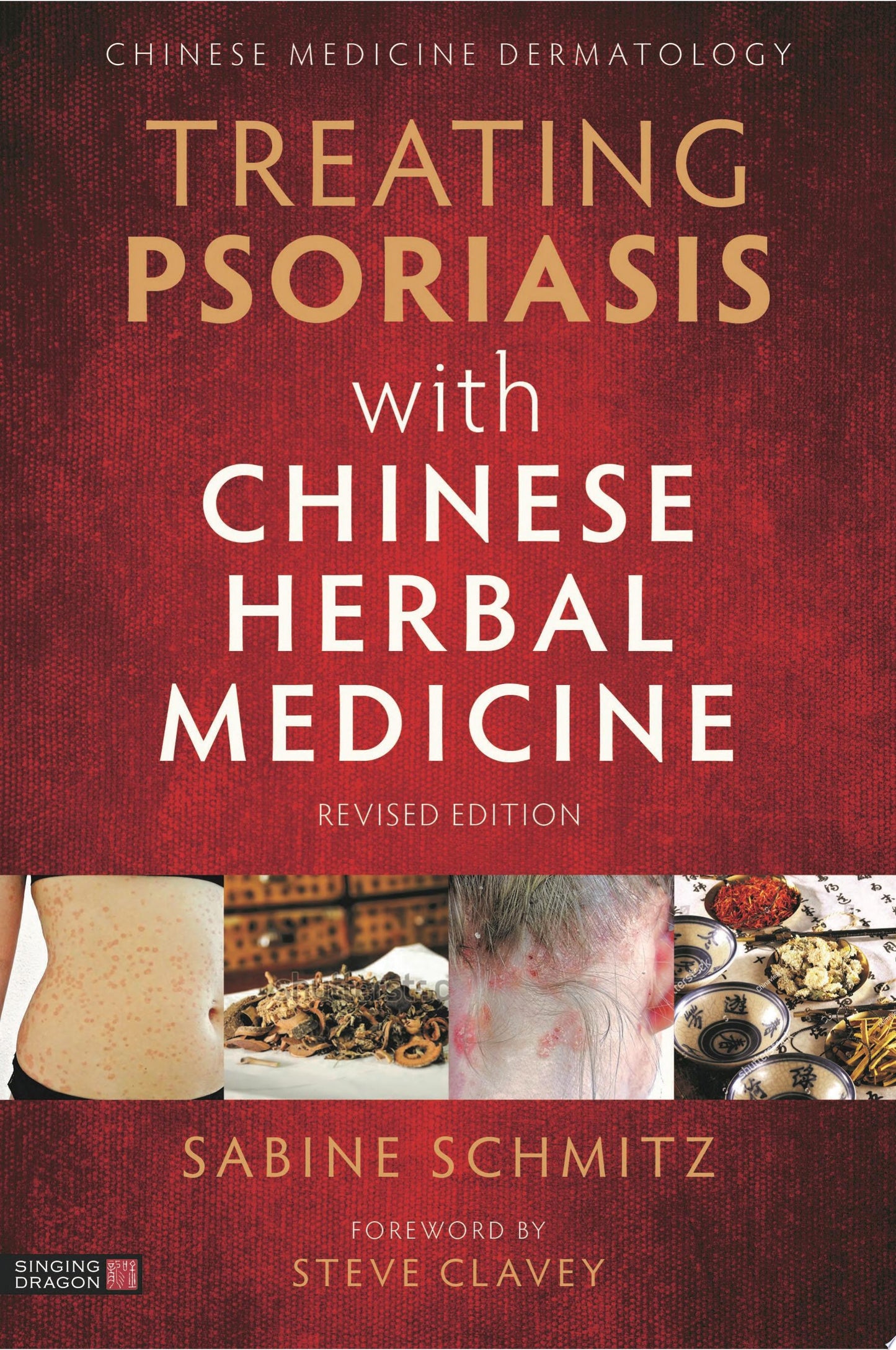 Treating Psoriasis with Chinese Herbal Medicine: A Practical Handbook