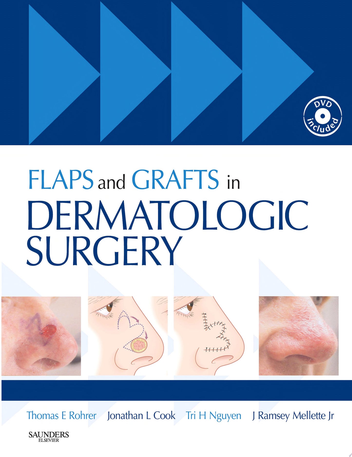 Flaps and Grafts in Dermatologic Surgery, 1st Edition