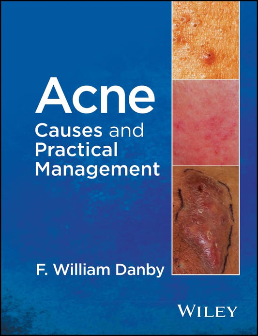 Acne: Causes and Practical Management