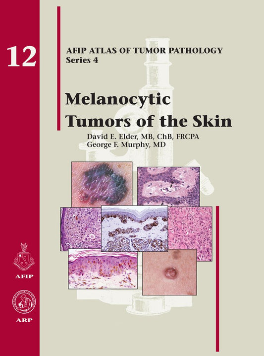 Melanocytic Tumors of the Skin