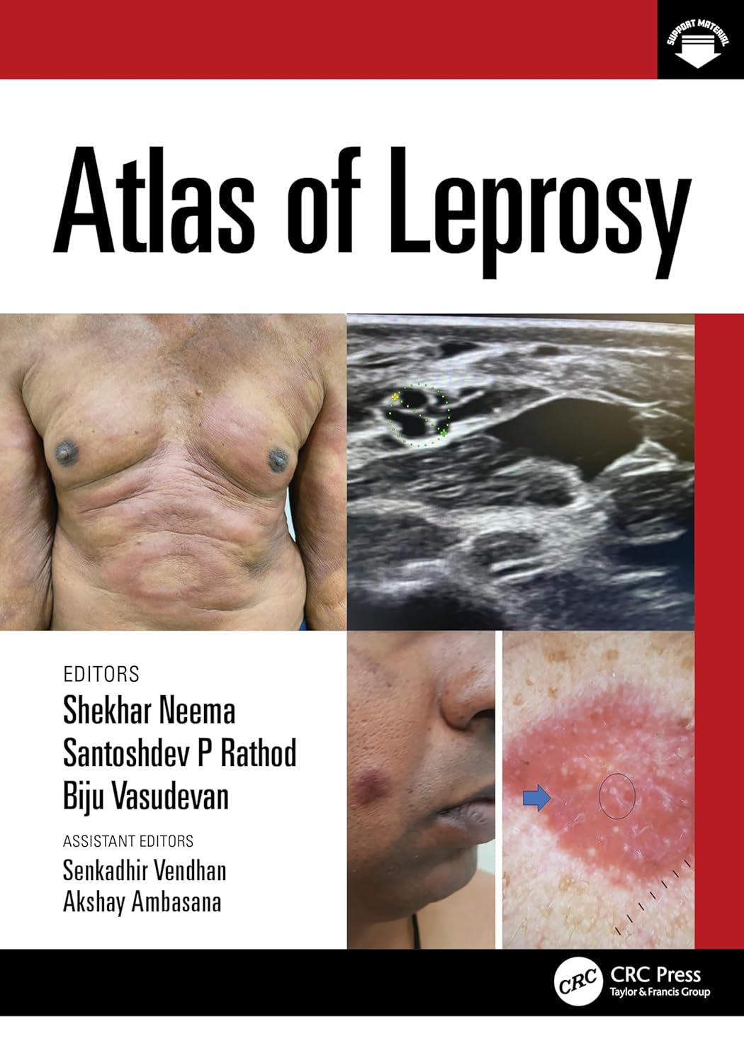 Atlas of Leprosy