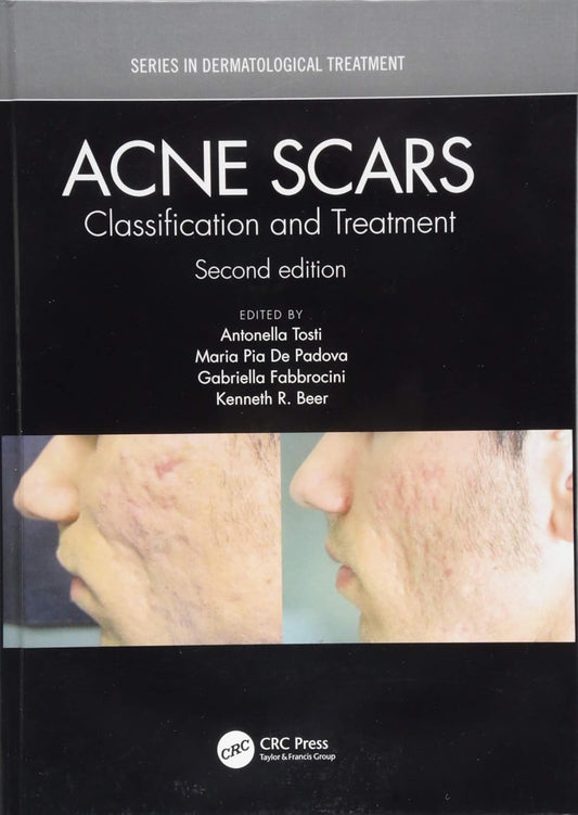 Acne Scars: Classification and Treatment, 2ed