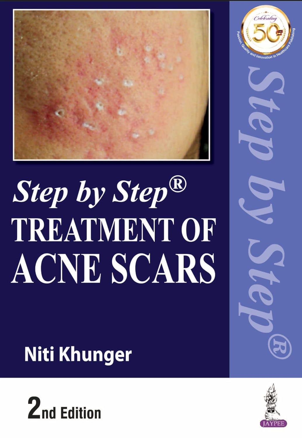 Step by Step Treatment of Acne Scars, 2nd Edition