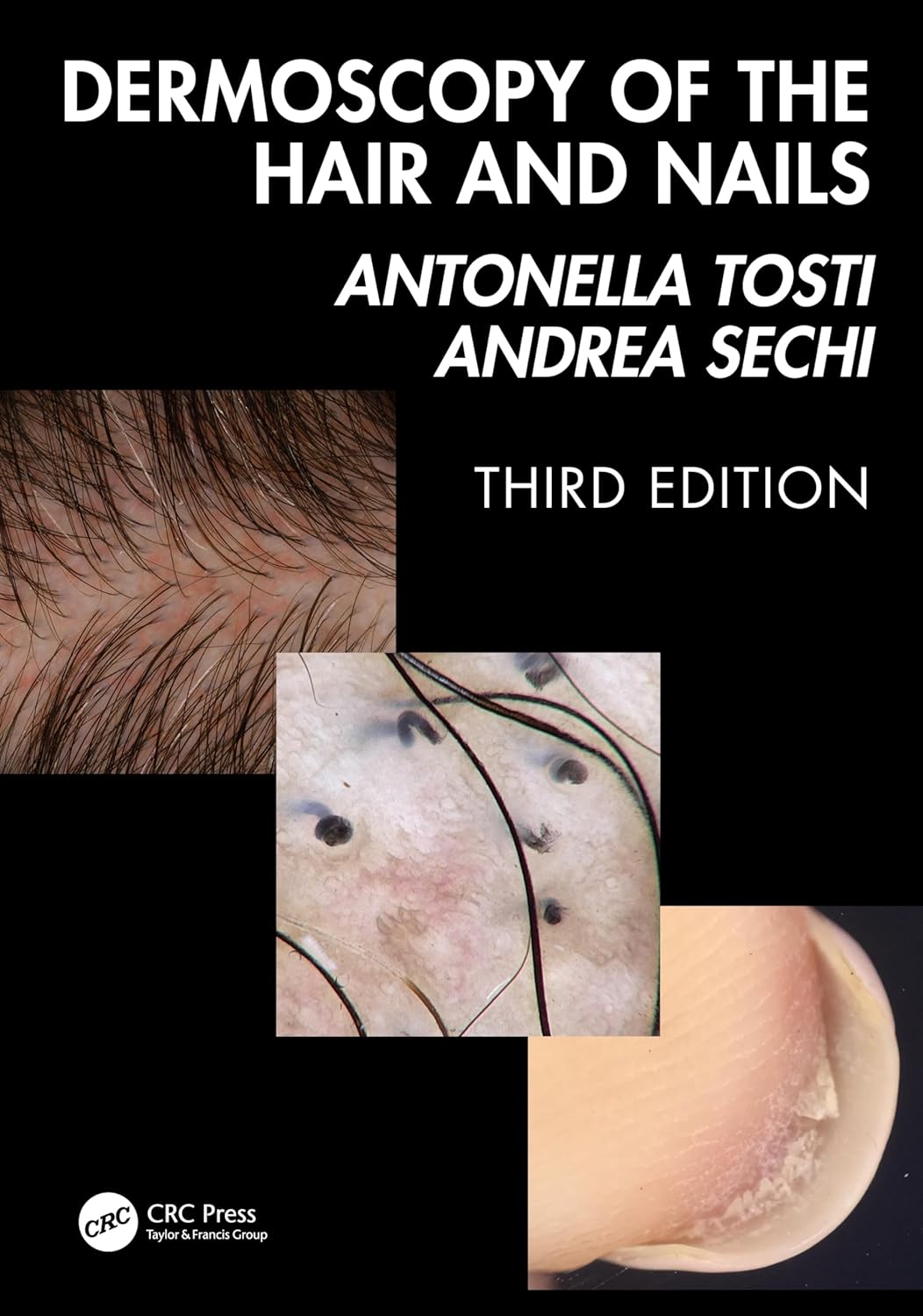 Dermoscopy of the Hair and Nails, 3rd Edition