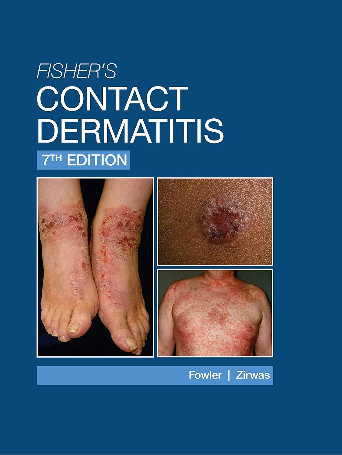 Fisher’s Contact Dermatitis, 7th Edition