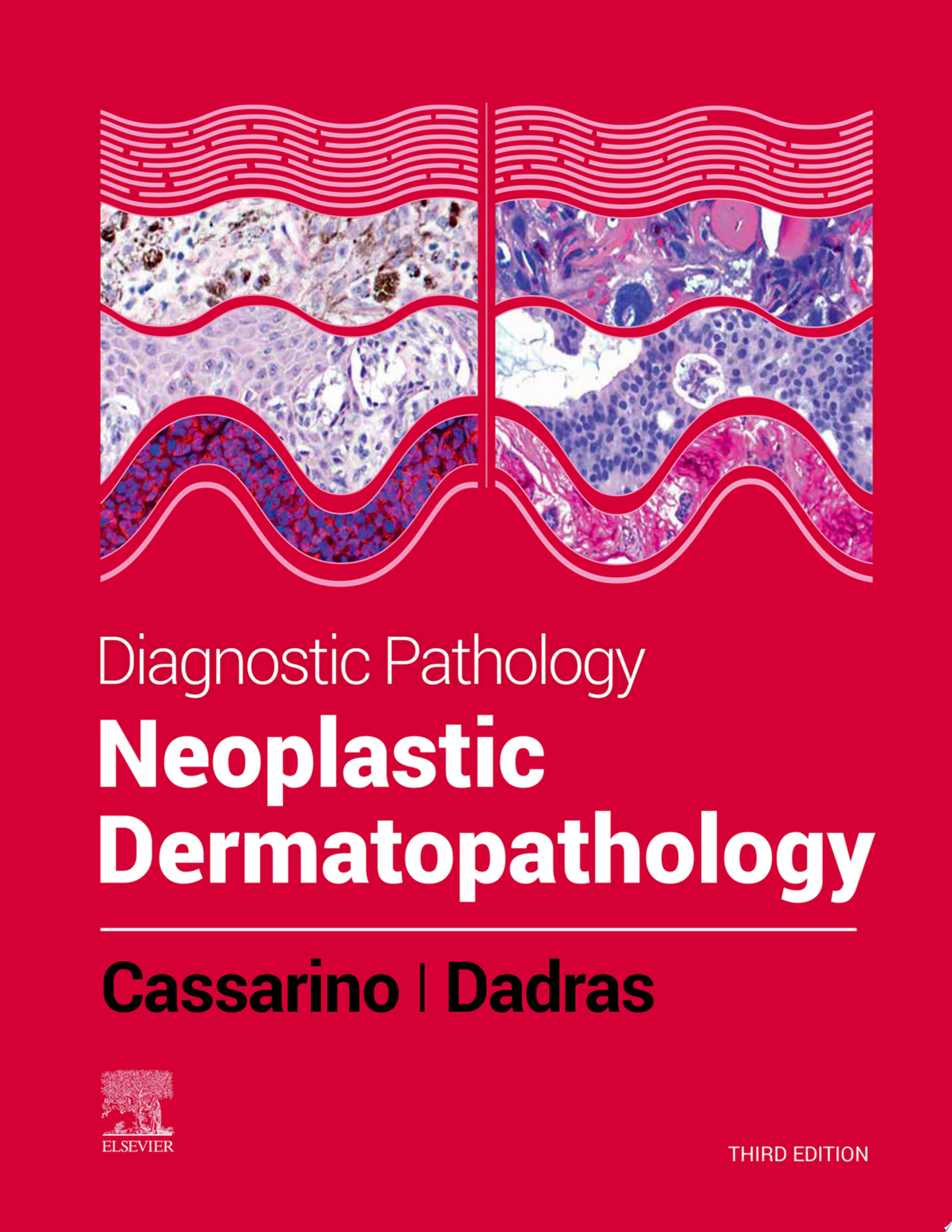 Pathology of Melanocytic Tumors