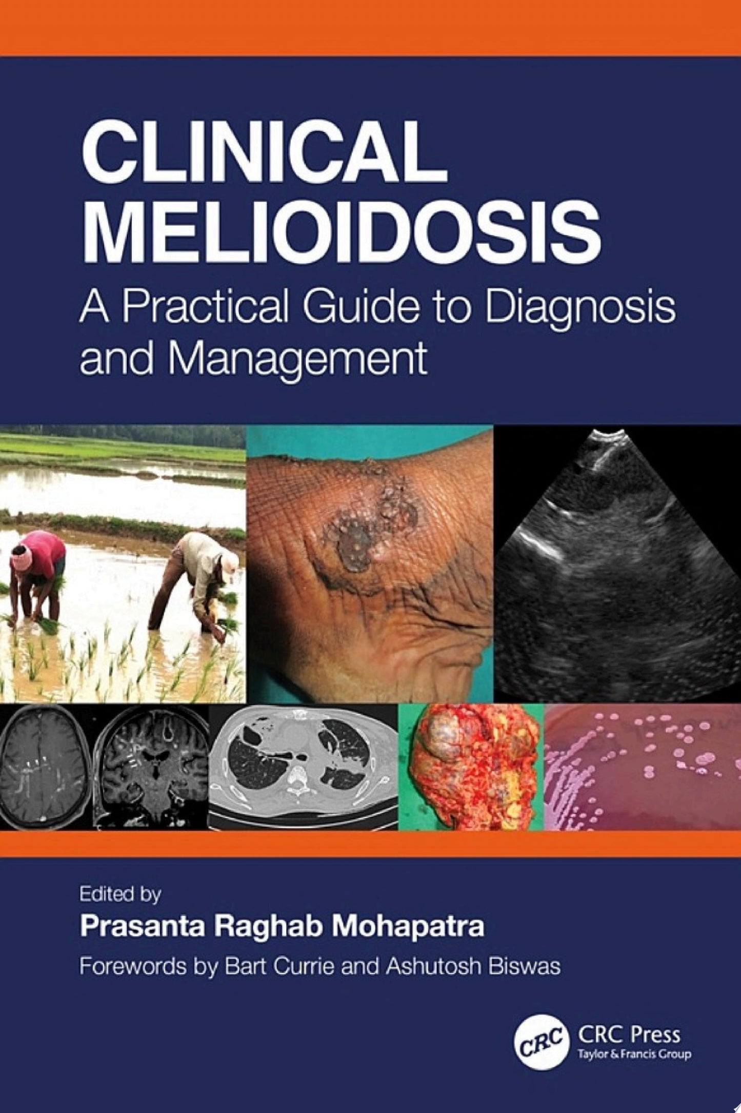 Clinical Melioidosis: A Practical Guide to Diagnosis and Management
