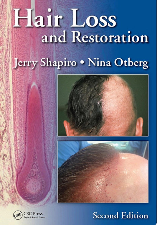 Hair Loss and Restoration, 2nd Edition