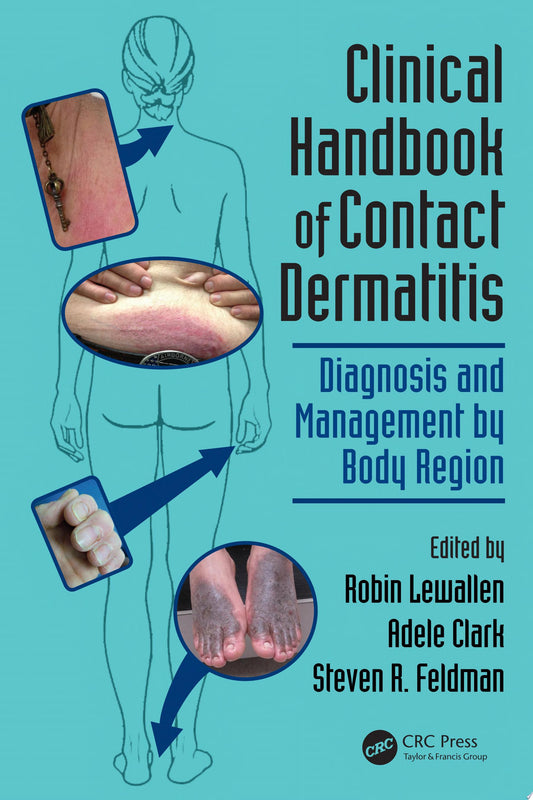 Atopic Dermatitis: From Diagnosis to Treatment