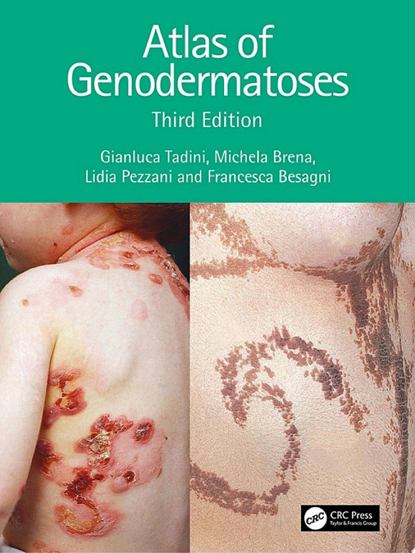 Atlas of Genodermatoses 3e