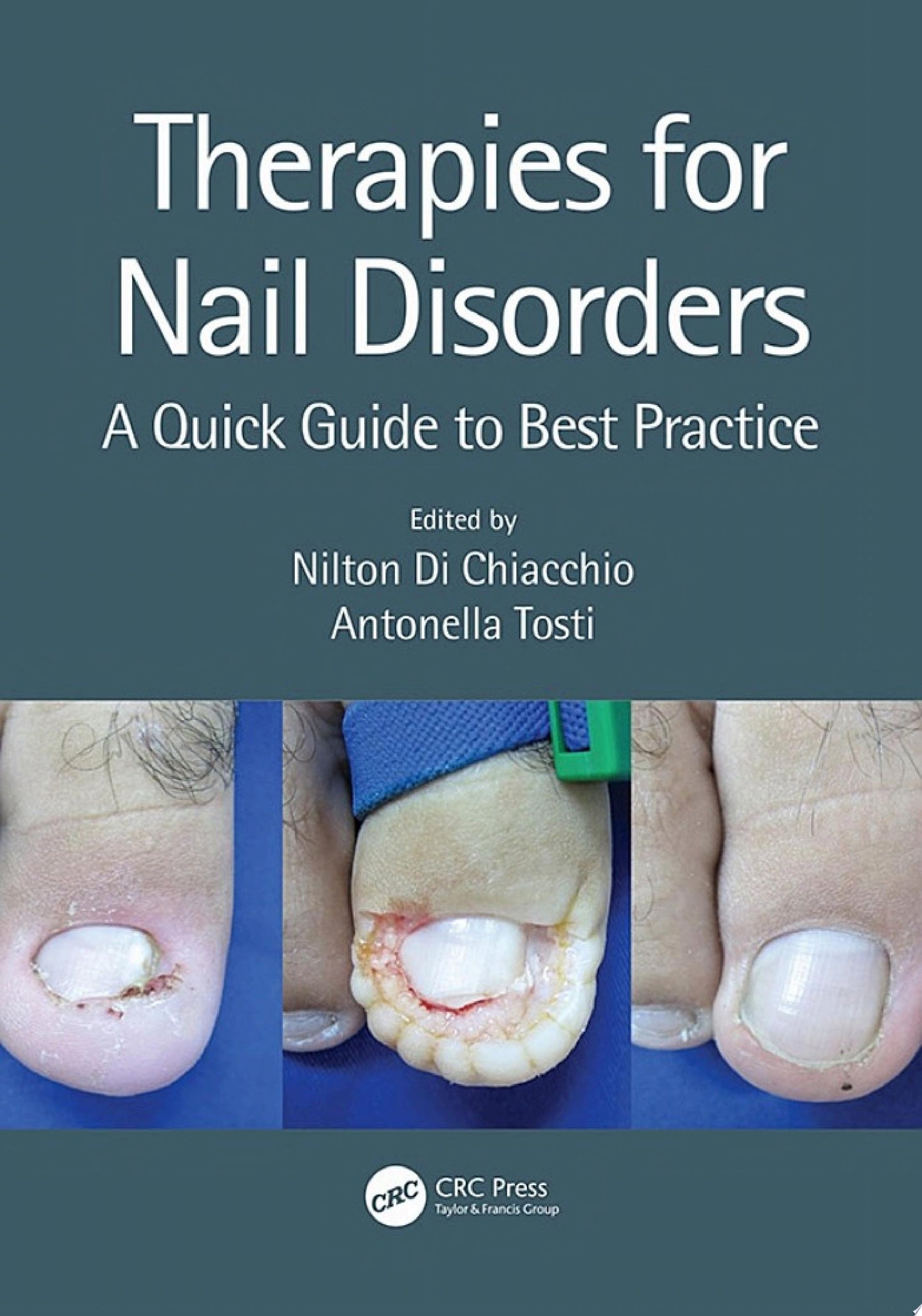 Therapies for Nail Disorders A Quick Guide to Best Practice
