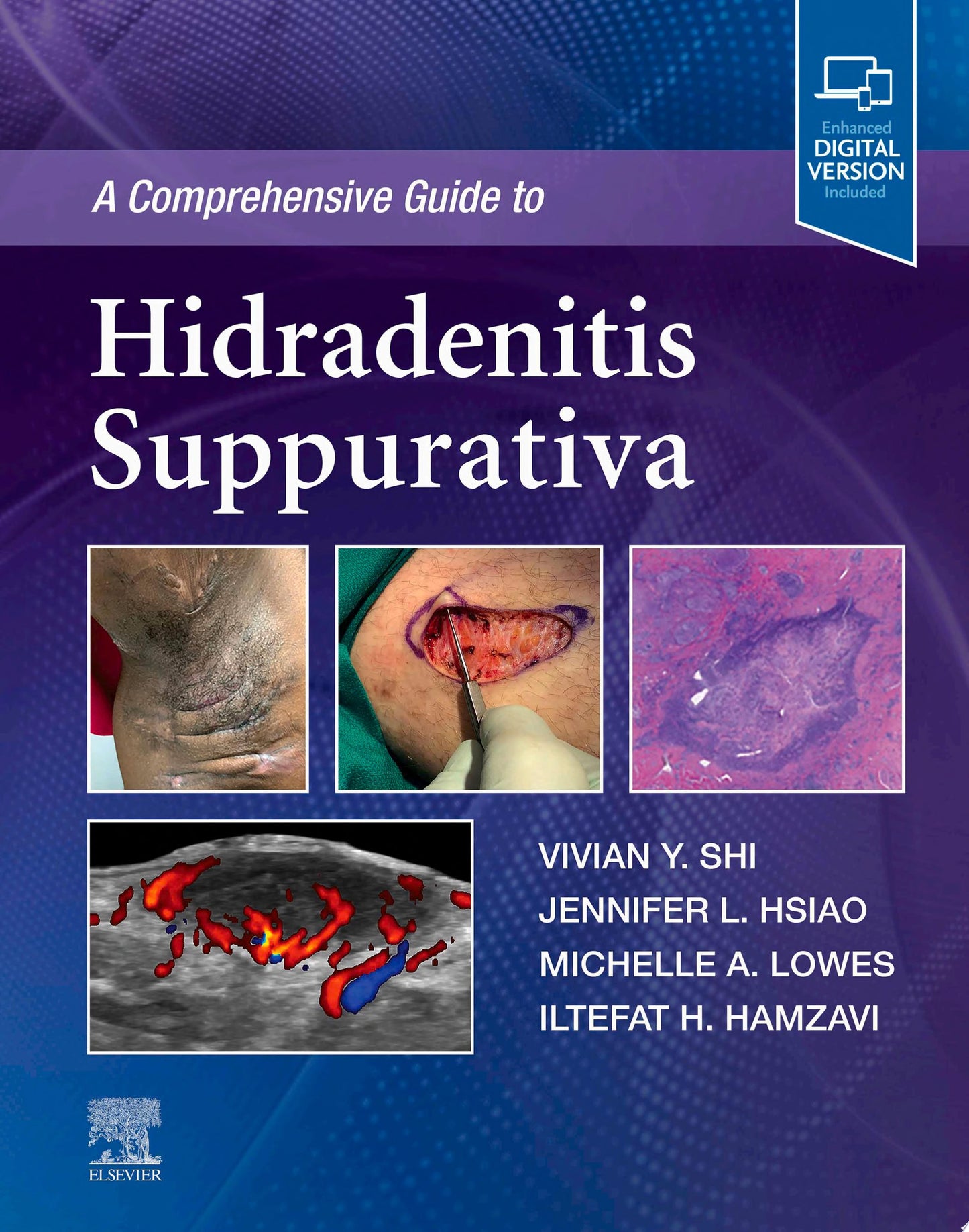 A Comprehensive Guide to Hidradenitis Suppurativa