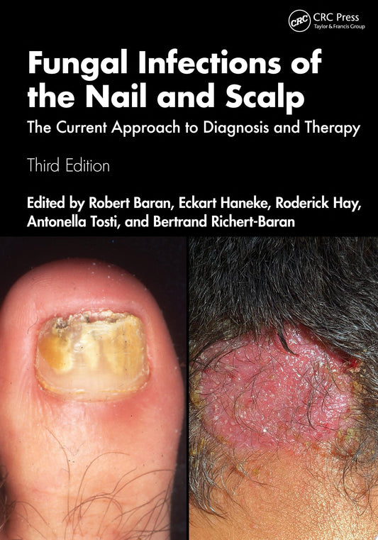 Fungal Infections of the Nail and Scalp: The Current Approach to Diagnosis and Therapy, 3rd Edition