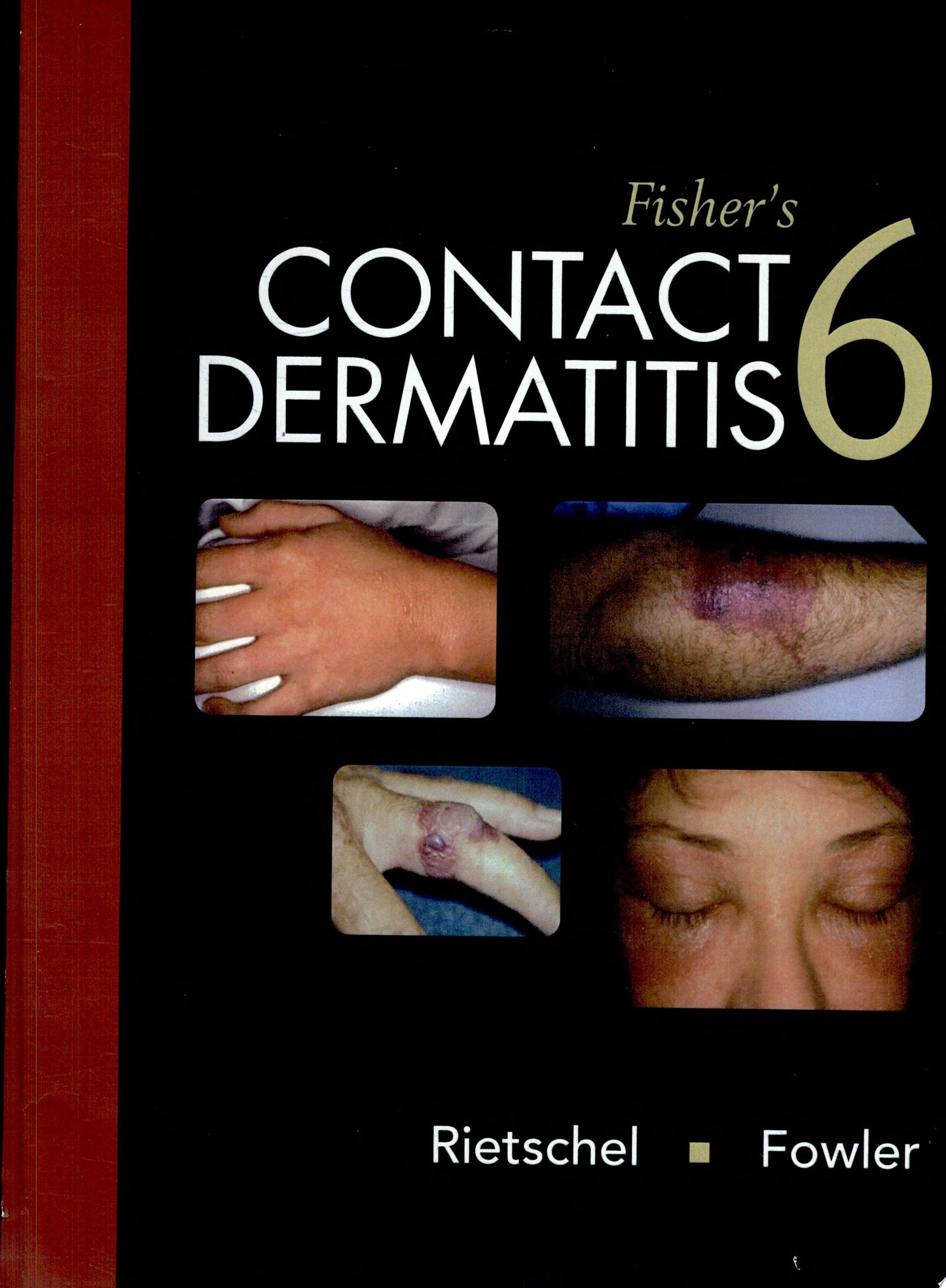 Fisher’s Contact Dermatitis, 6th Edition