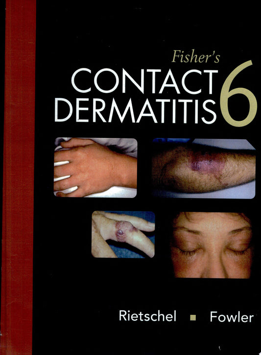 Fisher’s Contact Dermatitis, 6th Edition