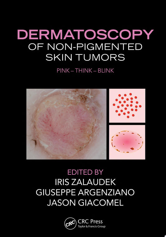 Dermatoscopy of Non-Pigmented Skin Tumors: Pink – Think – Blink
