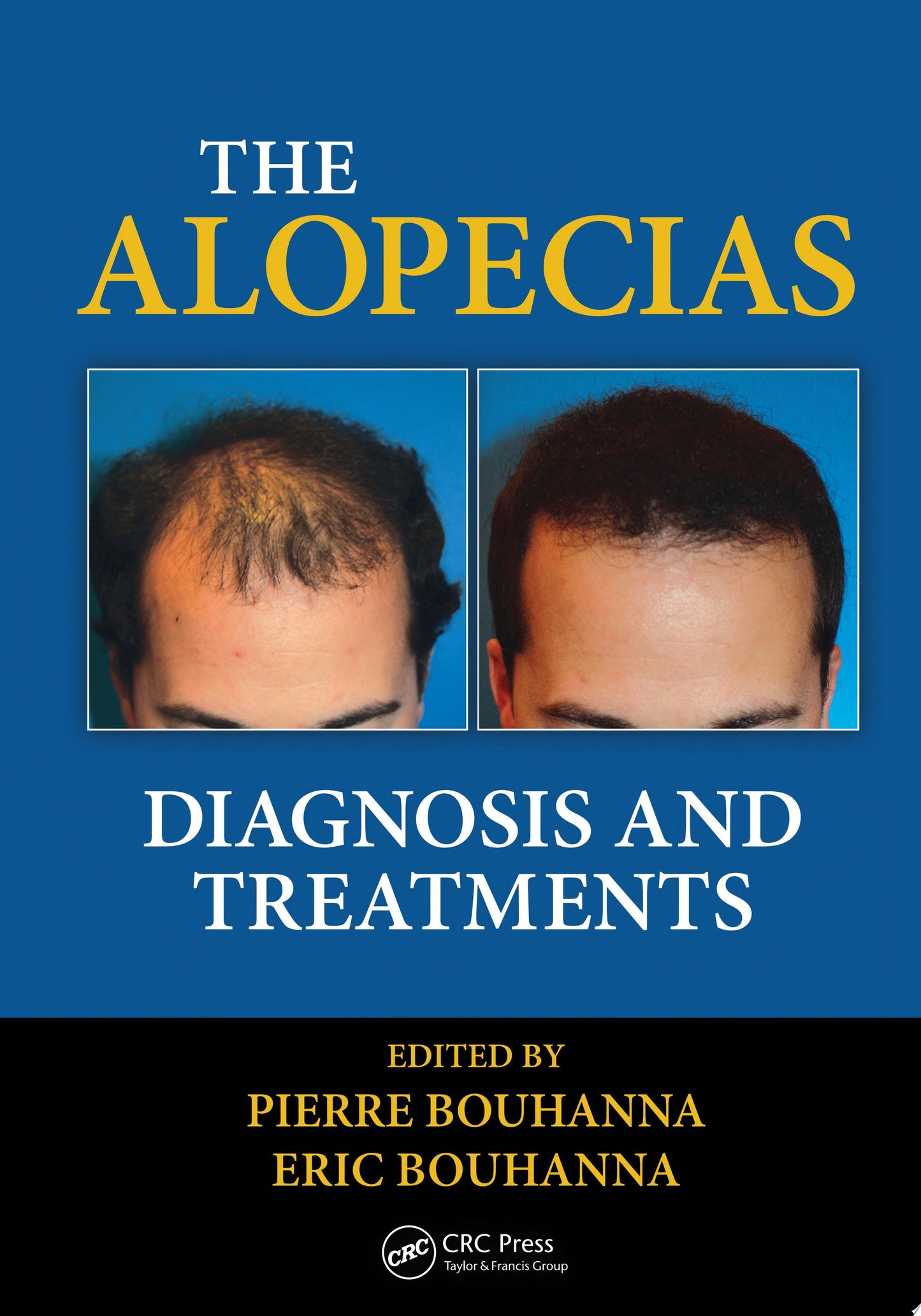 The Alopecias: Diagnosis and Treatments