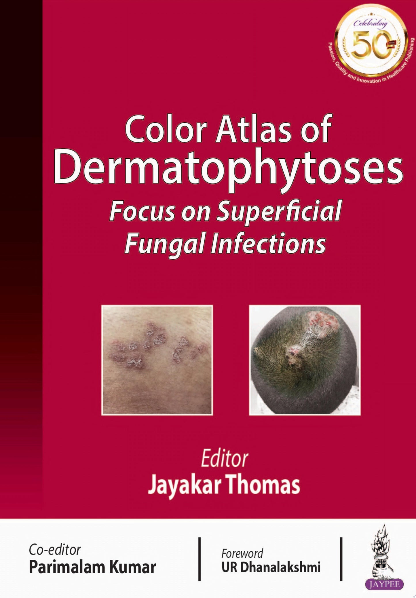 Color Atlas of Dermatophytoses: Focus on Superficial Fungal Infections