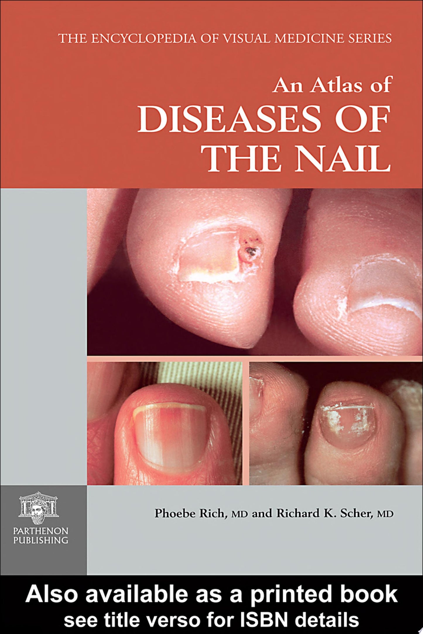 Atlas of Nail Signs and Disorders with Clinical and Onychoscopic Correlation