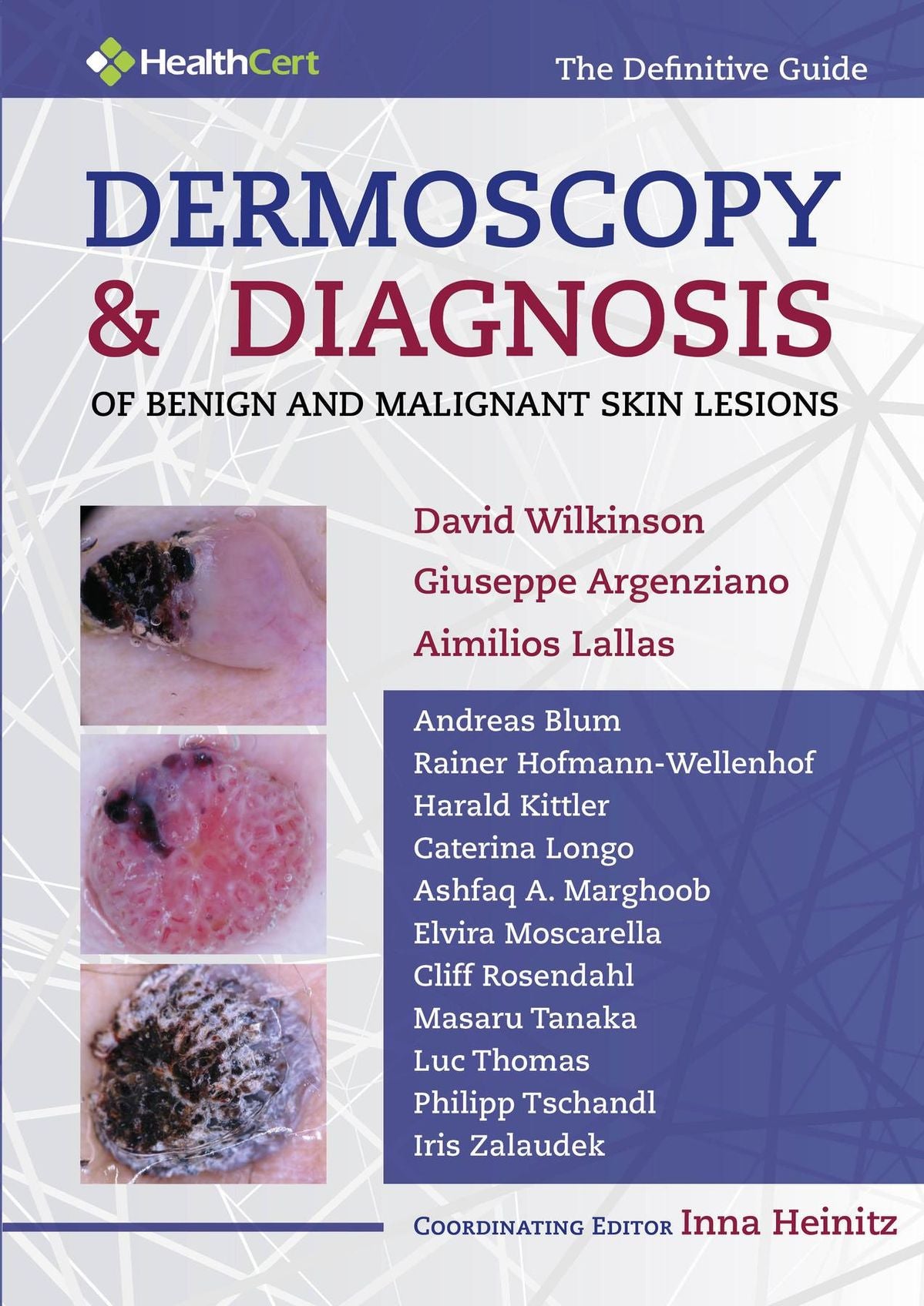 Dermoscopy and Diagnosis of Benign and Malignant Skin Lesions